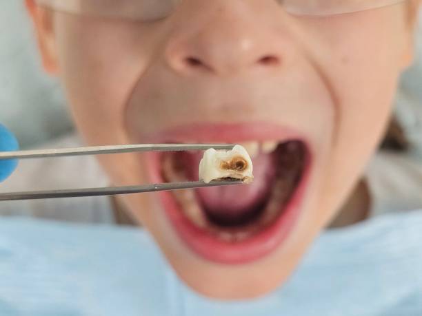 Best Emergency Treatment for Dental Infections or Abscesses in Bridgeport, WV
